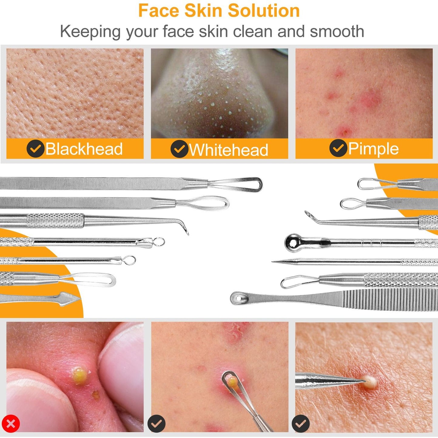 Face skin solution tools for removing blackheads, whiteheads, and pimples; includes images of skin conditions alongside stainless steel extraction instruments.