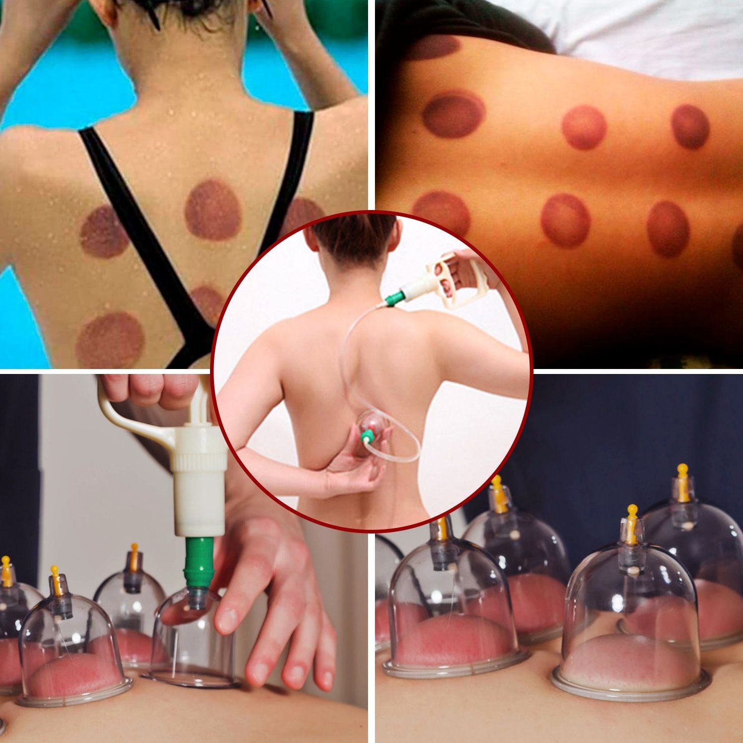 Cupping therapy process image showing various back views of individuals receiving treatment with suction cups, highlighting the benefits of traditional wellness techniques for muscle recovery and relaxation.
